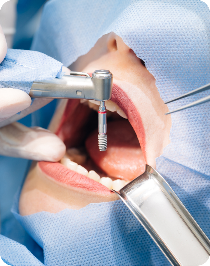 Implantes dentales en Montellano